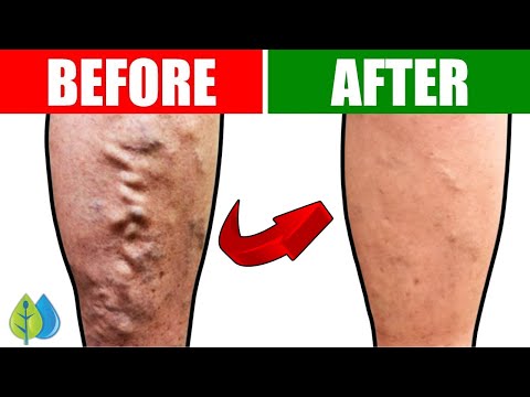 Top 5 Drinks to INSTANTLY Improve Leg Circulation &amp; Blood Flow