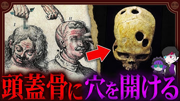 【グロ注意】脳みそ丸出し…頭蓋骨に穴を開ける風習「トレパネーション」