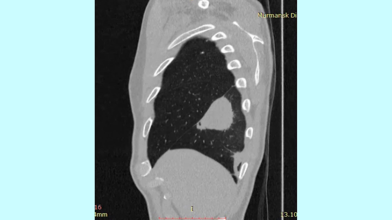 Микоплазменная пневмония. Mycoplasmal pneumonia.