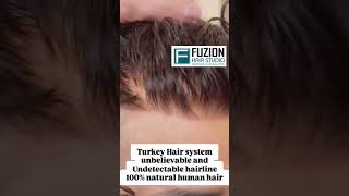 Skin Base Hair Patch System | 100% Natural Look Most comfortable and natural looking hair patches