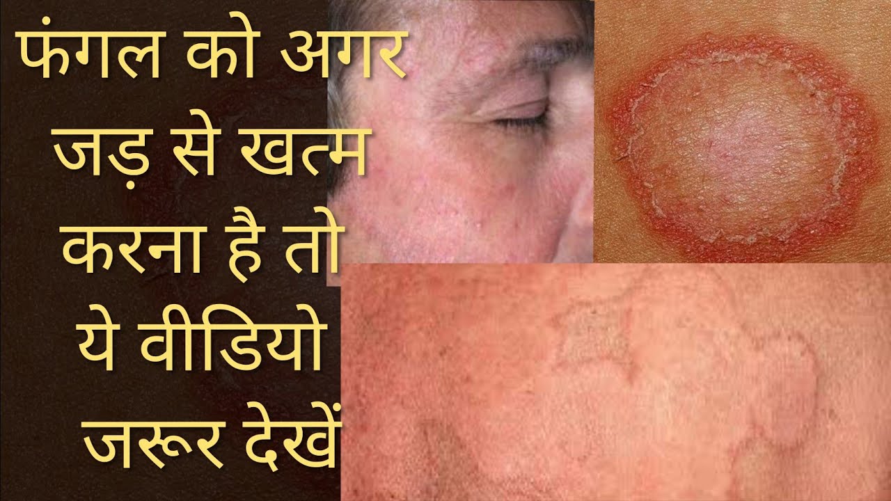 Best treatment for fungal infection जिंदगी में कभी दाद नही होगा अगर