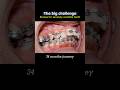 The big challenge braces: Fix severely overbite teeth in 34 months. #braces #dentist #orthodontics