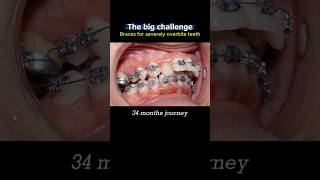 The big challenge braces: Fix severely overbite teeth in 34 months. #braces #dentist #orthodontics