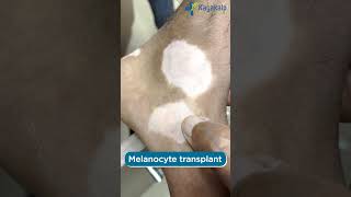 Melanocyte Transplantation for Vitiligo  shorts kayakalpglobal