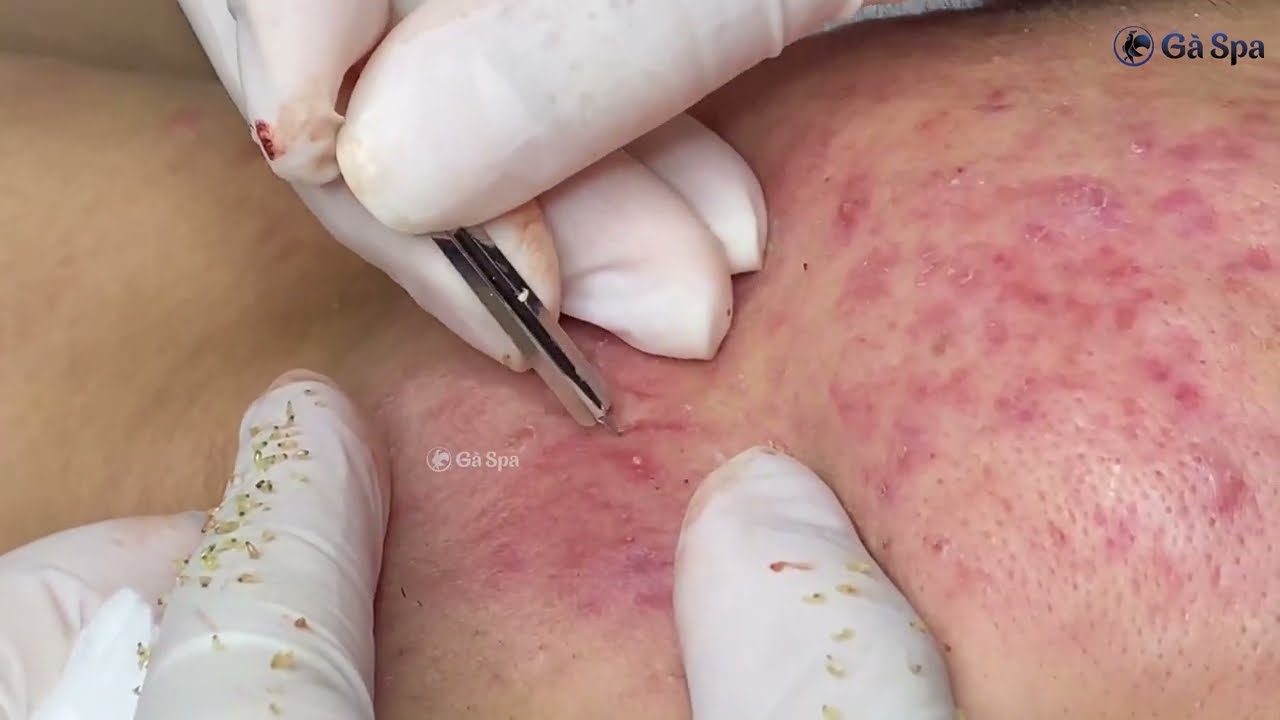 Acnes Treatment P3