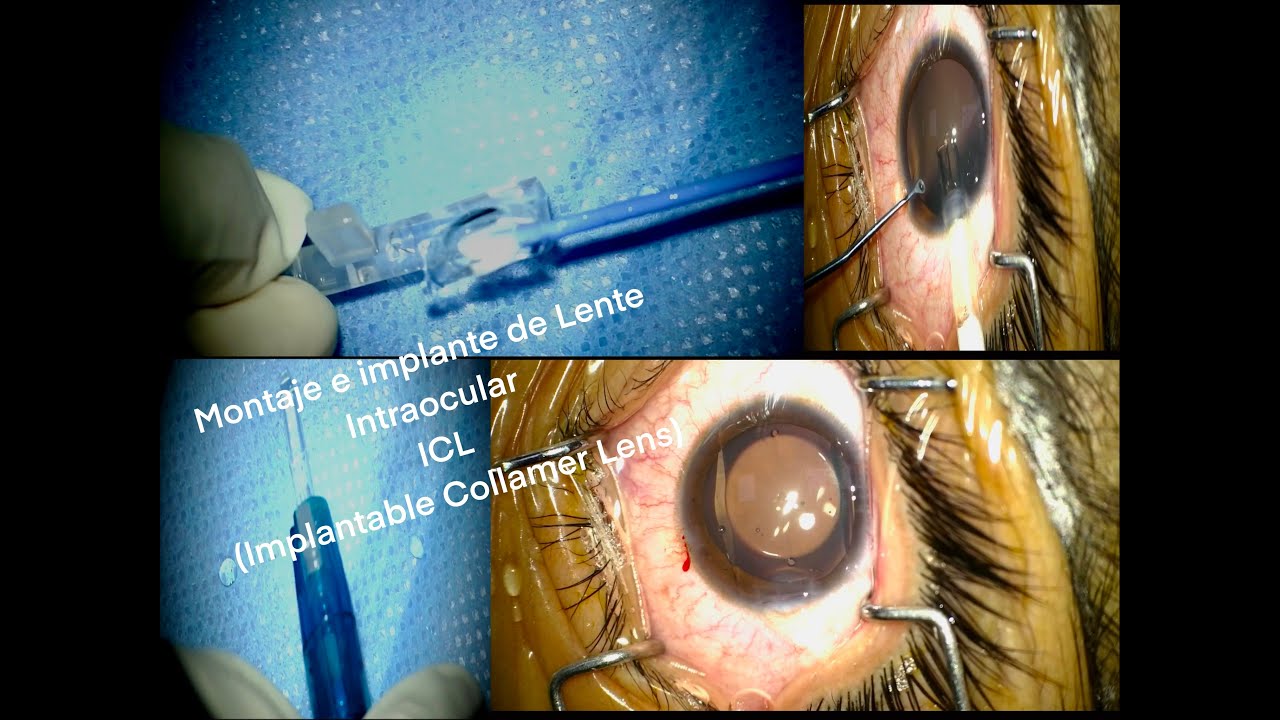 Oftalmólogo Córnea, Ciudad de Mexico - Lente Intraocular ICL, image size:1280x720