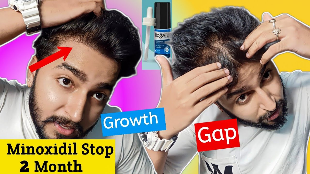 Minoxidil Stop 2 Month After Hair Gaping and Results | My Routine - YouTube