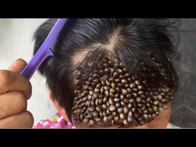 Do ticks like being in your hair  YouTube