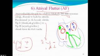 Atriyal Flutter