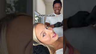 Rinomodelacion 👃🏼 #rinofiller #rinomodelacion #juvederm