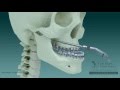Avanco de maxila e recuo de mandibula  Ortognatica FelipeFirme Buco maxilo facial