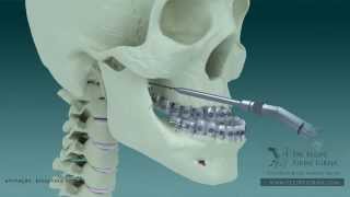 Avanco de maxila e recuo de mandibula  Ortognatica FelipeFirme Buco maxilo facial