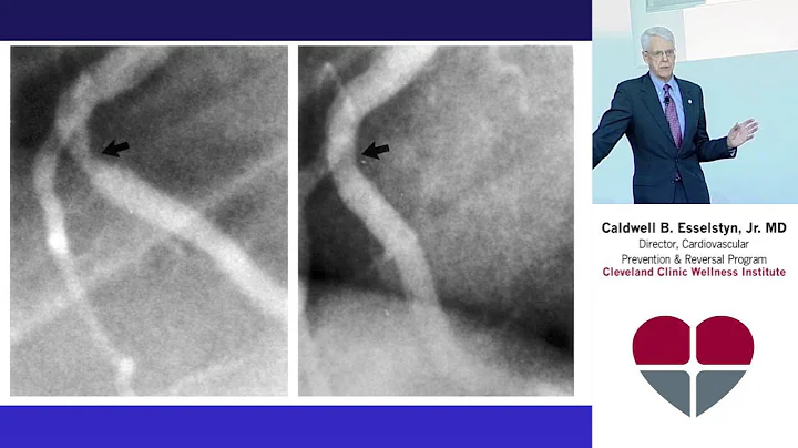 Caldwell B. Esselstyn, Jr. MD, Treating the Cause to Prevent and Reverse Heart Disease