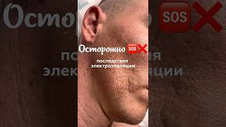 Электроэпиляция: шрамы на 10 лет! Почему лазерная эпиляция безопаснее? #лазернаяэпиляция