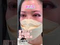 眼瞼下垂後の眉下リフトの症例です🧑⚕️ #眉下リフト #眉下切開 #美容整形 #整形 #ダウンタイム