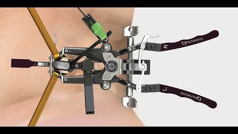 Nuvasive: X360 Procedural Animation