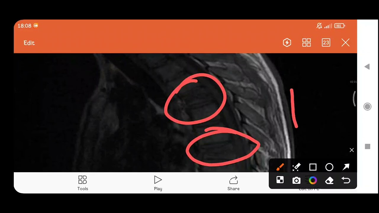 Umurtqa pogʻonasi  sinish darajalari   va rentgen, mrt va mskt da koʻrinishi .