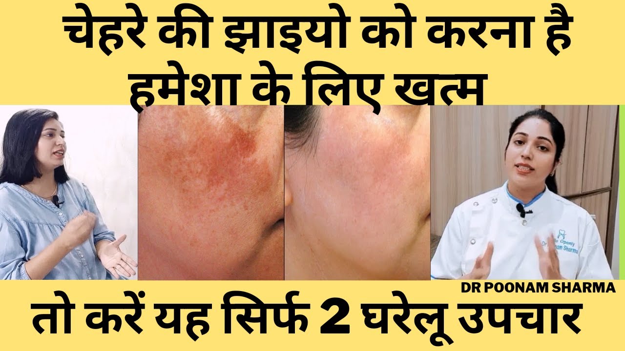 चेहरे की झाइयों को ठीक करने के दो घरेलु उपचार | Two Home Remedies To Cure Facial Freckles
