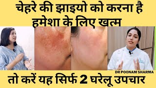 चेहरे की झाइयों को ठीक करने के दो घरेलु उपचार | Two Home Remedies To Cure Facial Freckles