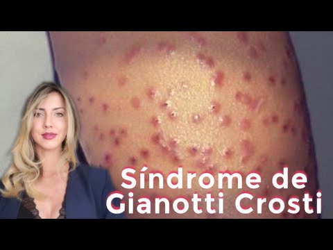 Síndrome de Gianotti Crosti