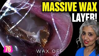 The Deeper I Go… The More Earwax &amp; Keratin Appears | Wax Off Episode 76