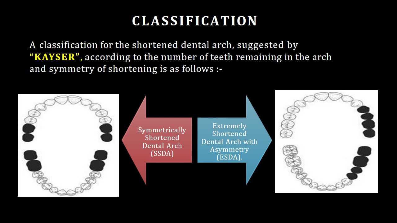 Shortened Dental Arch SDA CONCEPT YouTube