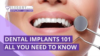 Dental Implants 101: All The Basics You Need To Know 🦷
