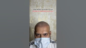 GET RID OF BALDNESS WITH SCALP MICROPIGMENTATION #scalpmicropigmentation #smp #scalpdots