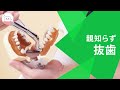 水平埋伏親知らず（右下8番）の抜歯！横向きや水平に埋まった親知らず、ありませんか？ Lower Right No.8 Wisdom Tooth Extraction