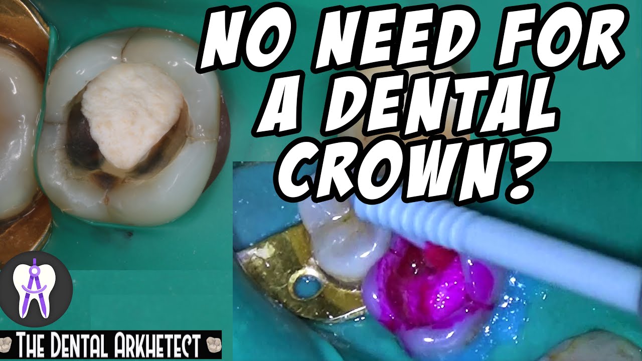 Restoring a Root Canal Treated Tooth with Composite #C11 - YouTube