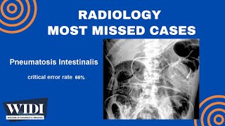 Most Missed Cases: Pneumatosis Intestinalis