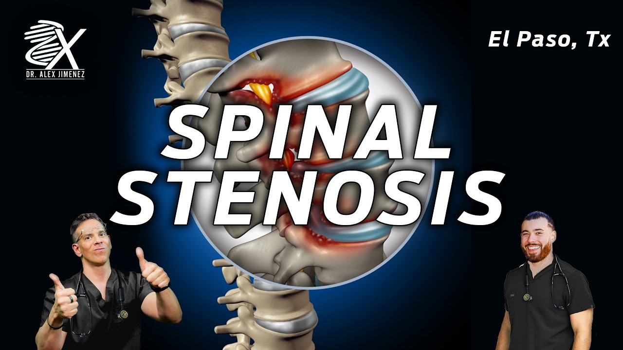 The Root Causes of Spinal Stenosis | El Paso, Tx (2023)