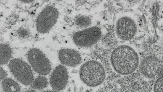 US declares monkeypox a public health emergency — what that means for Chicago