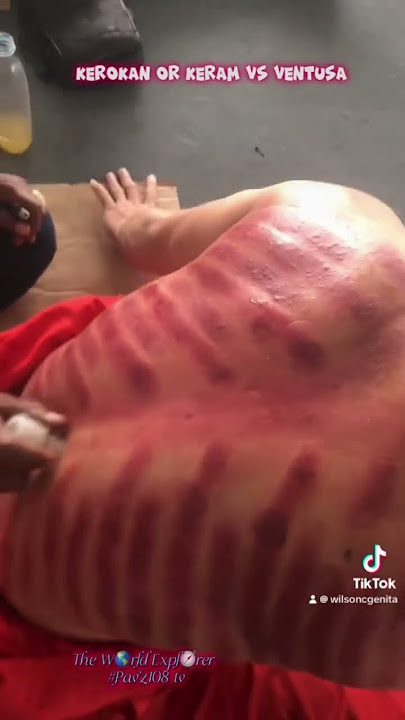 Kerokan o Keram in Indonesia #keram #kerokan #ventusa #massage
