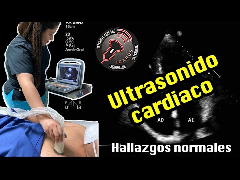 Ultrasonido cardíaco: Hallazgos normales By ICARUS