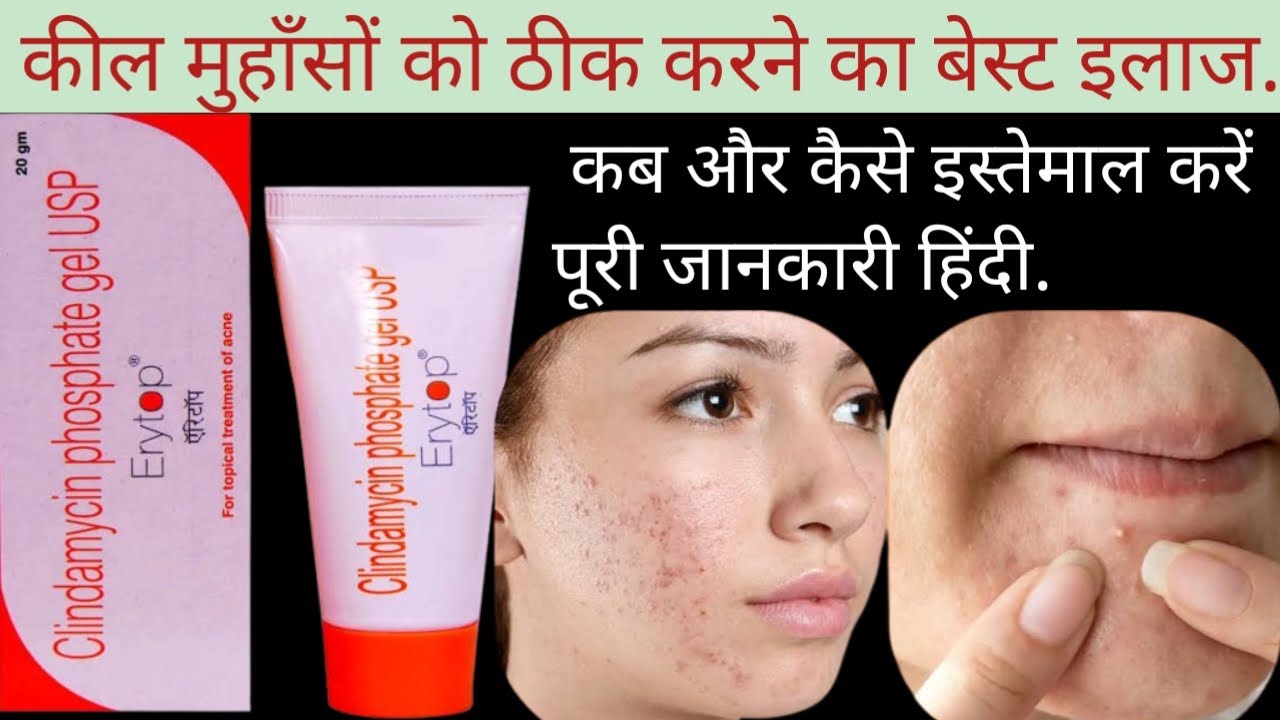 Erytop a gel ke Fayde. Erytop a Cream Uses in Hindi. Adapalene & Clindamycin gel.