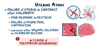 Uterine Atony; uterus fails to contract effectively after childbirth