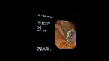 a huge stone of  CBD . ERCP sphincterotomy . extraction after dilatation baloon 18mm .