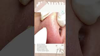 Big Cystic Acne Blackheads Extraction Blackheads & Milia, Whiteheads Removal Pimple Popping shorts