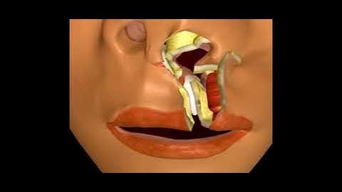 Rotation Advancement Cleft Lip Repair