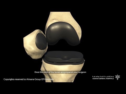 جراحة استبدال مفصل الركبة (الكلي) | جراحة العظام