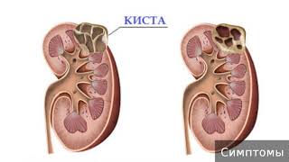 Киста почки. Как лечить кисту почки. Киста почки. Как лечить кисту почки.