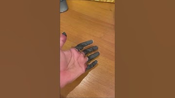 What frost bite looks like