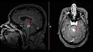 Brainstem Cavernous Malformation Removal