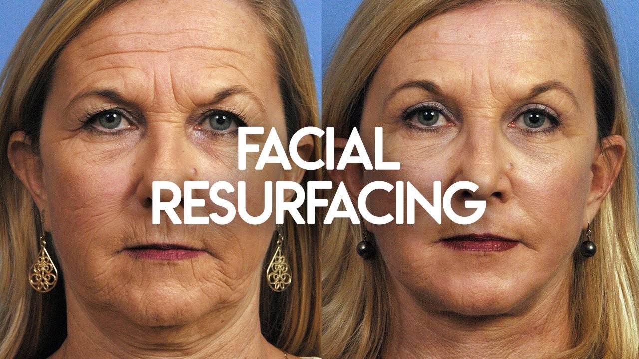 Facial Resurfacing
