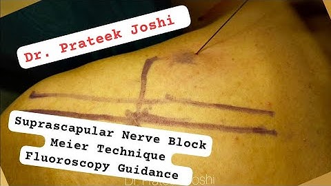 Suprascapular Nerve Block Procedure | Meier Technique + Fluoroscopy Guidance | Dr. Prateek Joshi