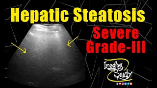 Severe Hepatic Steatosis || Severe Fatty Infiltration || Ultrasound || Case 172