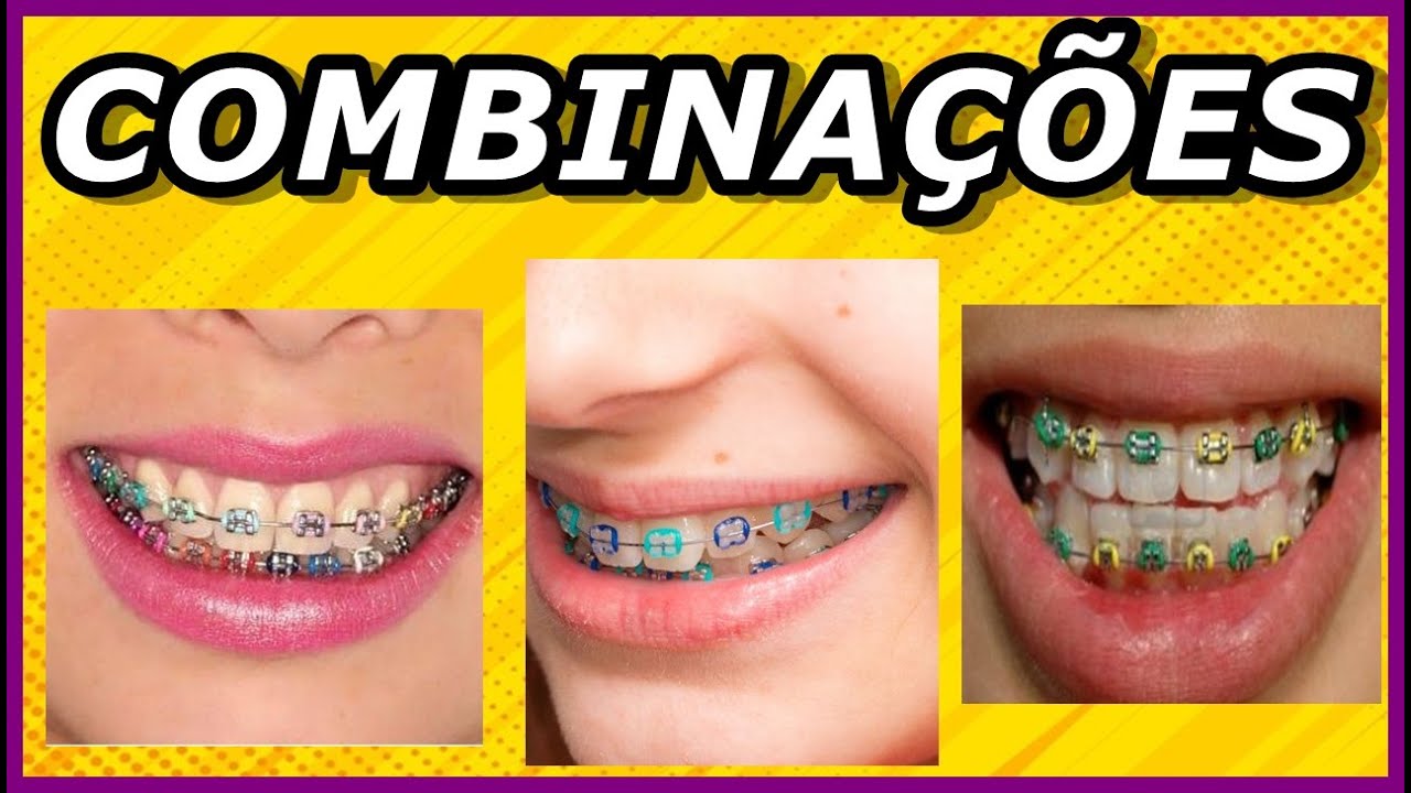 APRENDA A ESCOLHER AS MELHORES COMBINAÇÕES DE CORES PARA SEU APARELHO ORTODÔNTICO GUIA APRENDA A ESCOLHER AS MELHORES COMBINAÇÕES DE CORES PARA SEU APARELHO ORTODÔNTICO GUIA