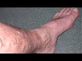 What kind of physiotherapy will help in treating varicose vein?