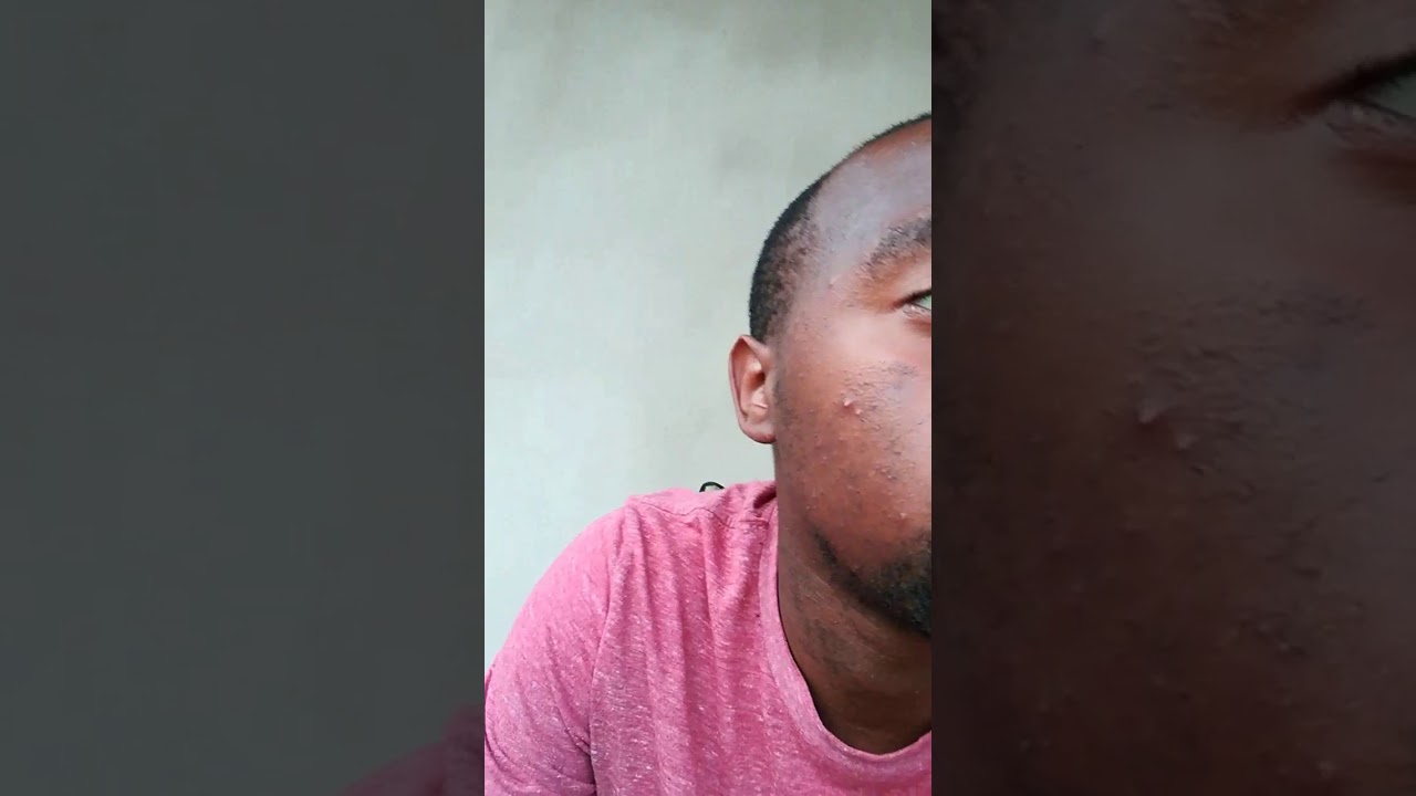 Had Popcorn Shells Stuck In My Teeth Youtube